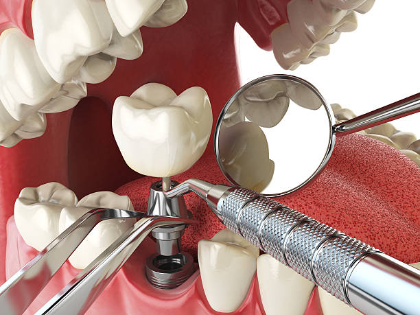 Best Emergency Dental Care for Abscessed Tooth in Reidsville, NC